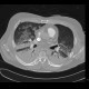 Lung contusion: CT - Computed tomography